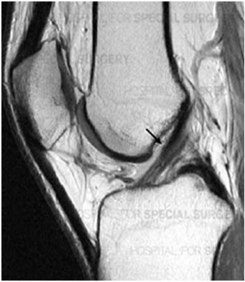 ACL Reconstruction surgery in Pimple saudagar, Pune at Helios Orthojoint