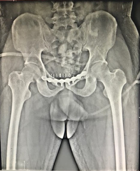 Pelvis And Acetabulum Surgery in Pimple saudagar, Pune at Helios Orthojoint