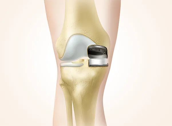 Best hospital for knee, Hip & joint replacement surgery In Pimple Saudagar, Pune | Helios Orthojoint