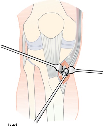 Cruciate Ligament Reconstruction in Pimple saudagar, Pune at Helios Orthojoint