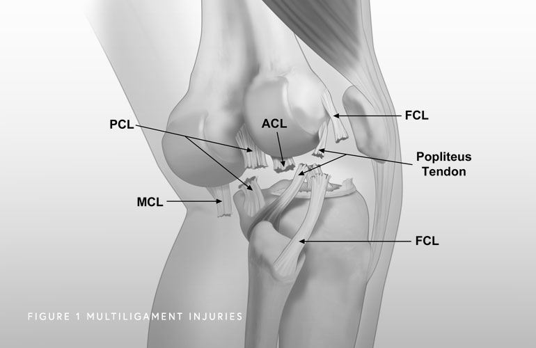 Multi Ligament Surgery in Pimple saudagar, Pune at Helios Orthojoint