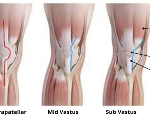 Muscle Sparing Total Knee Replacement