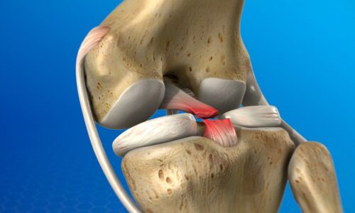 PCL Reconstruction surgery in Pimple saudagar, Pune at Helios Orthojoint