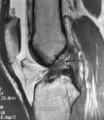 ACL Reconstruction surgery in Pimple saudagar, Pune at Helios Orthojoint