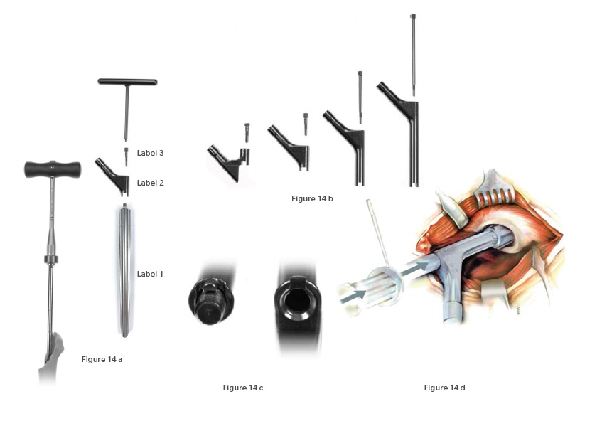 Revision Hip Replacement surgery in Pimple saudagar, Pune at Helios Orthojoint