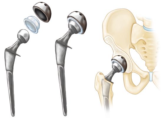 Hip Replacement surgery in Pimple saudagar, Pune at Helios Orthojoint