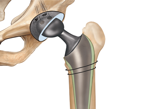 Best hospital for knee, Hip & joint replacement surgery In Pimple Saudagar, Pune | Helios Orthojoint