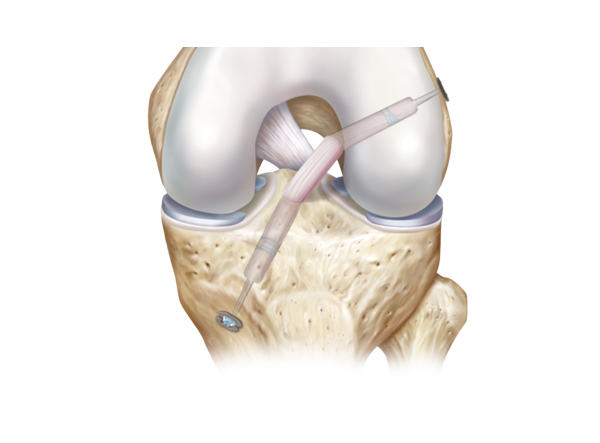 Best hospital for knee, Hip & joint replacement surgery In Pimple Saudagar, Pune | Helios Orthojoint