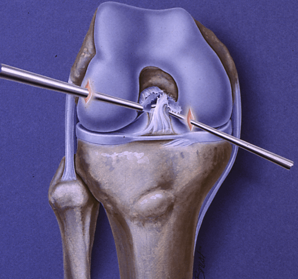 Torn Ligament in Knee, Knee Specialist
