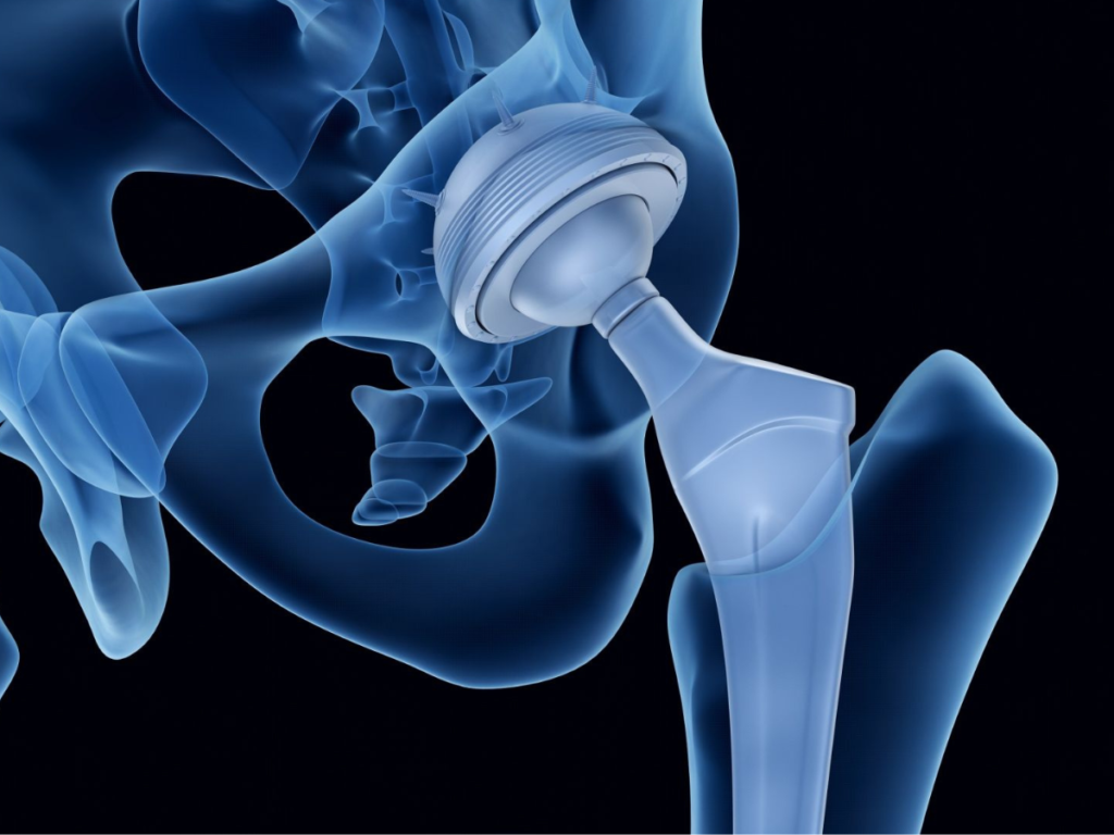 Knee Replacement Surgery Addressing Safety and Accuracy Concerns