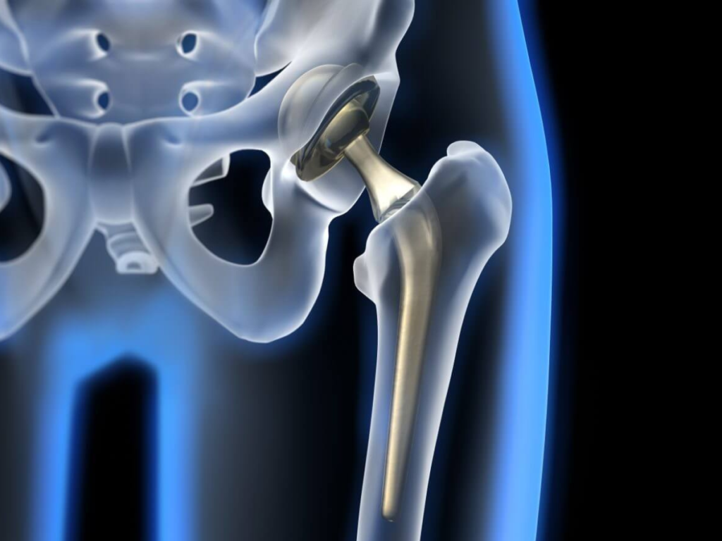 Knee Replacement Surgery Addressing Safety and Accuracy Concerns