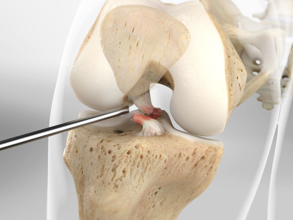 Knee Replacement Surgery Addressing Safety and Accuracy Concerns