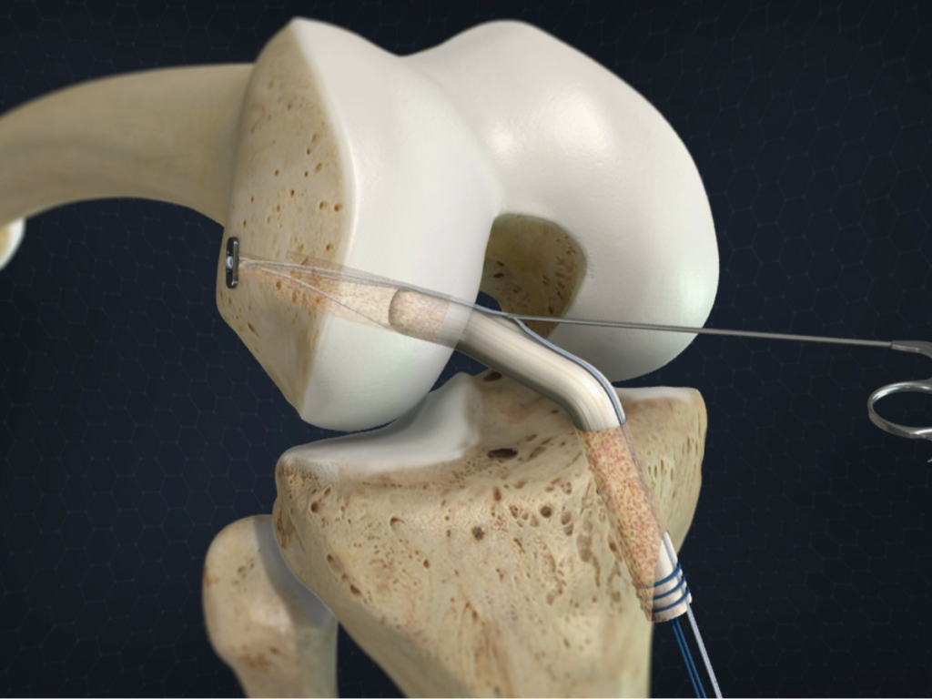 Navigating ACL Reconstruction Recovery: Essential Tips for a Seamless Rehabilitation