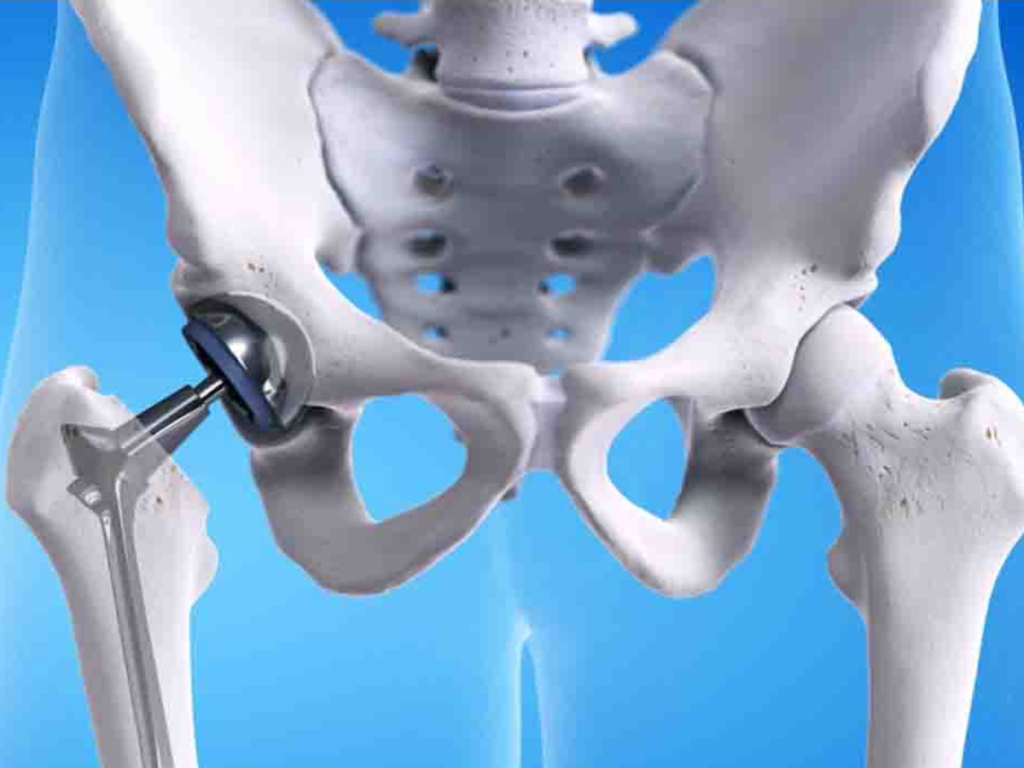 Navigating Life After Hip Replacement: A Comprehensive Guide