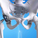 Navigating Life After Hip Replacement: A Comprehensive Guide