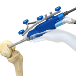 How Robotic Knee Replacement Improves Surgical Precision and Outcomes