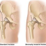 The Benefits of Minimally Invasive Hip Replacement Surgery