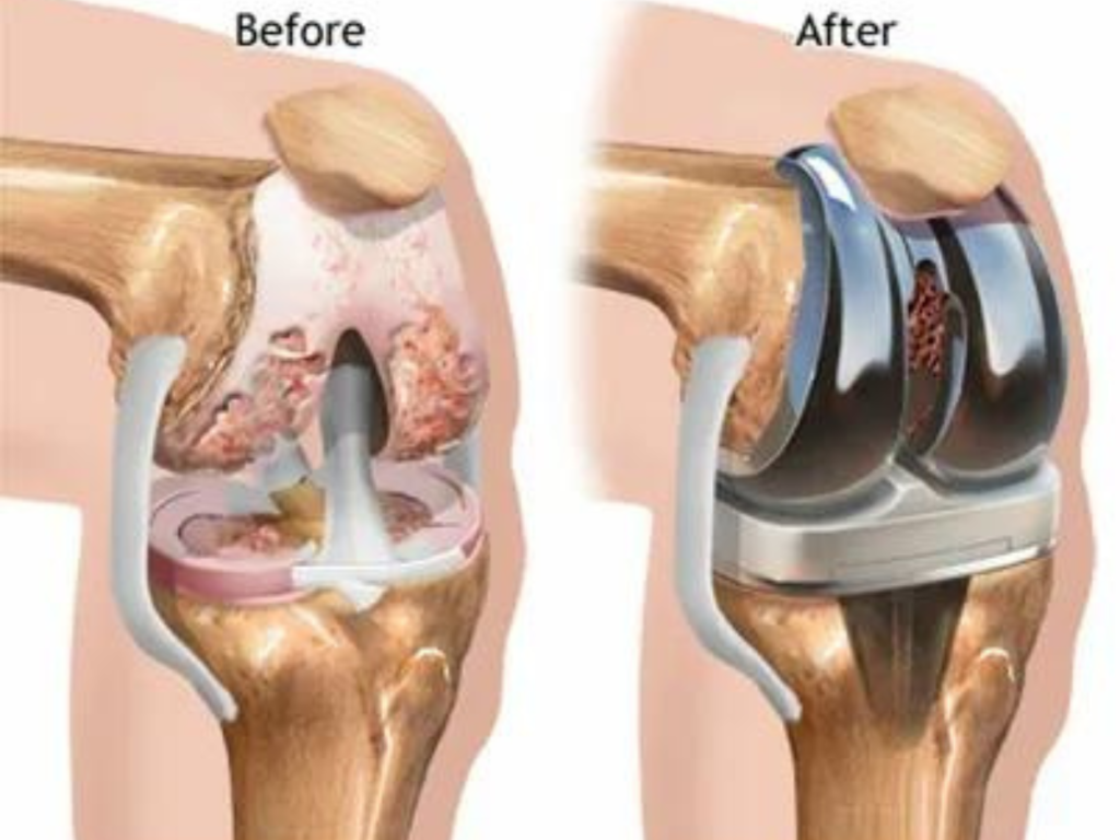 Recovery Timeline for Primary Knee Joint Replacement Surgery