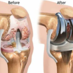 Recovery Timeline for Primary Knee Joint Replacement Surgery