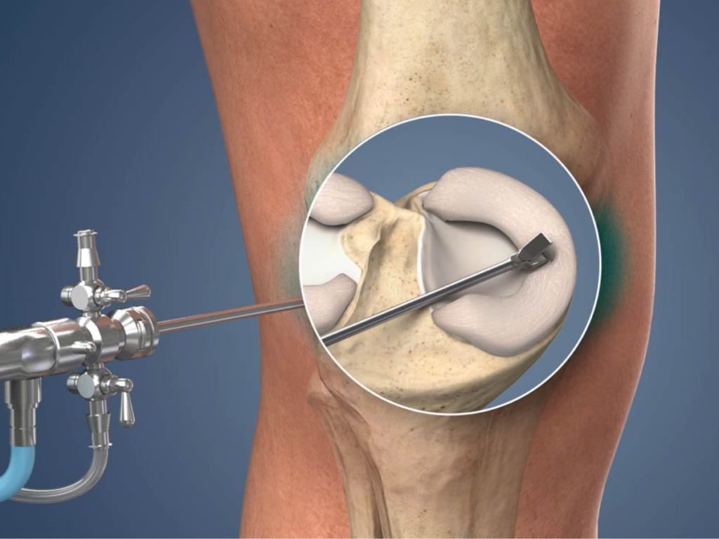 Recovery Tips for Patients Undergoing Meniscus Surgery