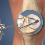 Recovery Tips for Patients Undergoing Meniscus Surgery