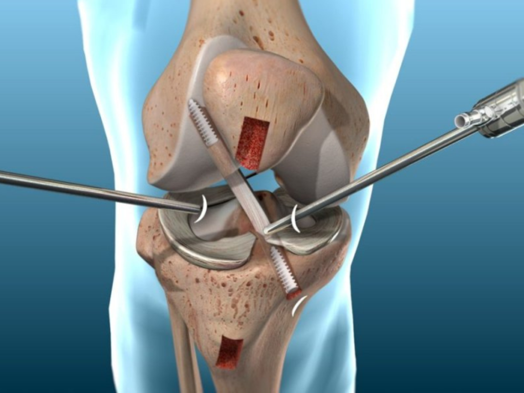 Post-Surgery Rehabilitation for ACL Reconstruction Patients