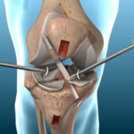 Post-Surgery Rehabilitation for ACL Reconstruction Patients