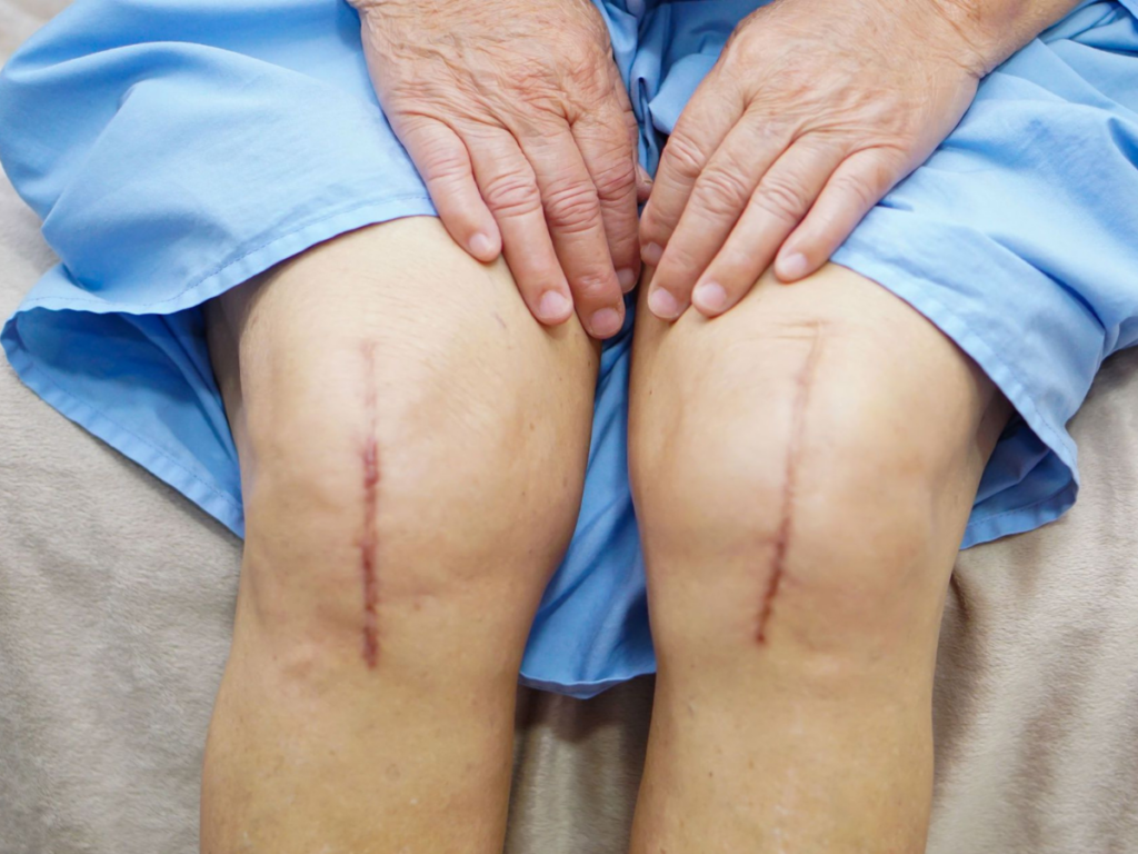 Knee Replacement Surgery