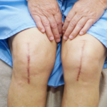 Knee Replacement Surgery