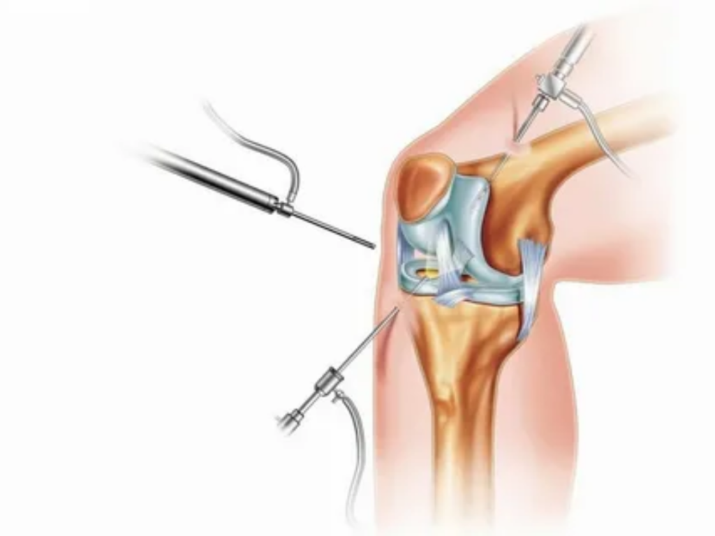 Arthroscopic Surgery