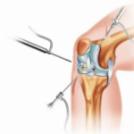 Arthroscopic Surgery